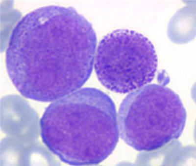 leucemia-infantil-5