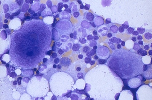 leucemia-mielogena