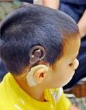 Niño con implante coclear