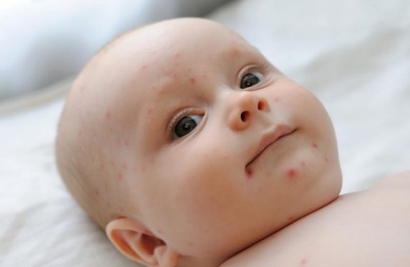 Síntomas de la varicela en bebés
