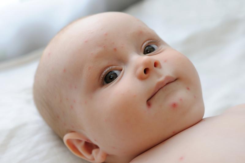 Los 4 síntomas que te ayudarán a saber si el bebé tiene la varicela